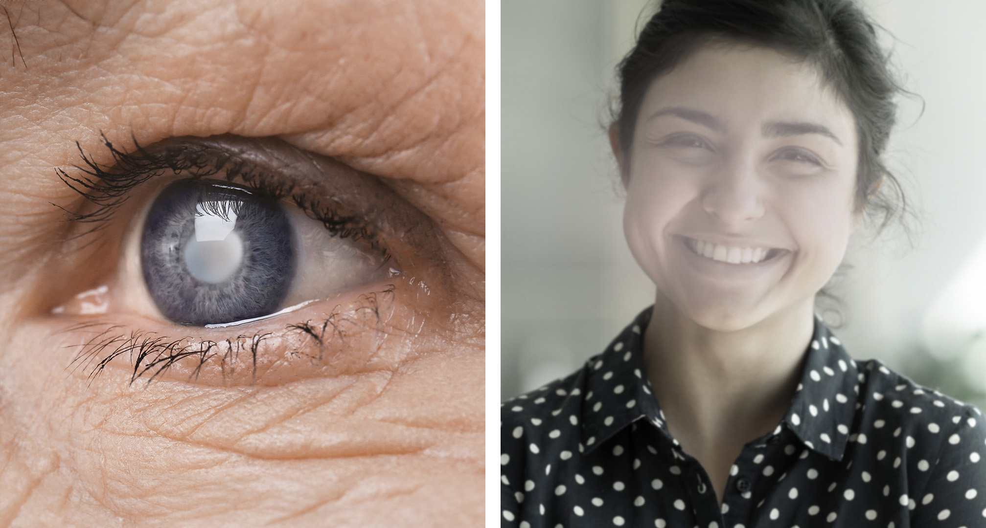 As cataratas podem aparecer como um disco branco ou turvo no cristalino (esquerda). Com o tempo, podem levar a visão turva ou nublada (direita).