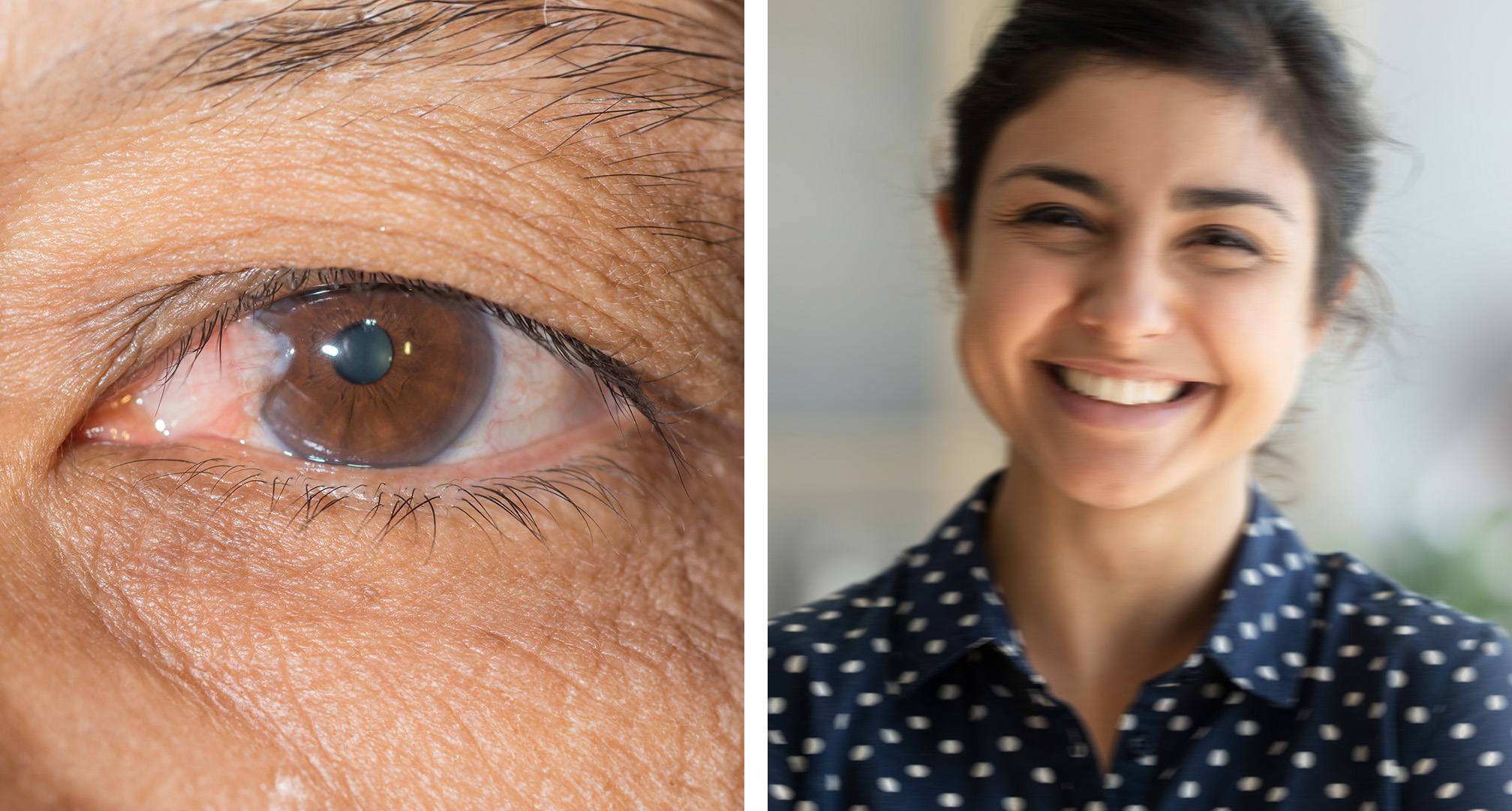 O pterígio é um crescimento em forma de cunha da conjuntiva que se estende sobre a córnea (esquerda). Em casos extremos, se o pterígio se expandir sobre a pupila, pode obstruir ou turvar a visão (direita).