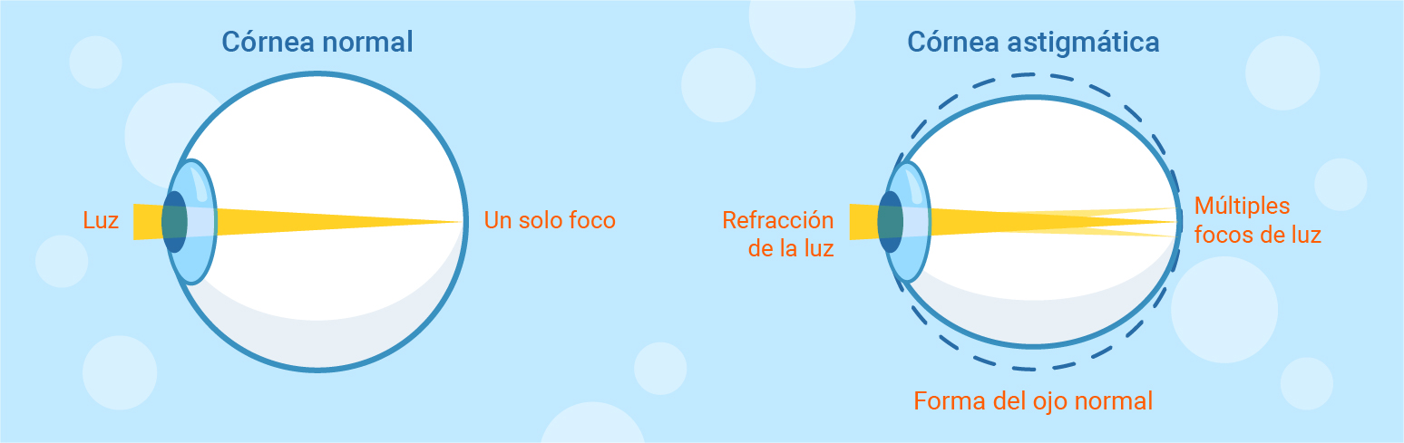 olho com astigmatismo